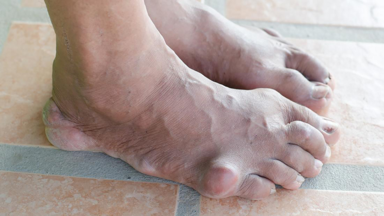 The Fiji Times » Gout a form of arthritis