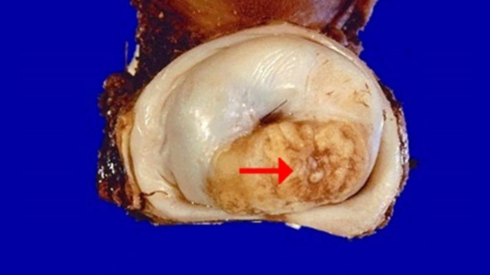 The Fiji Times » HPV vaccination Importance of cervical cancer screening